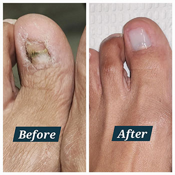 keryflex nail restoration before and after picture