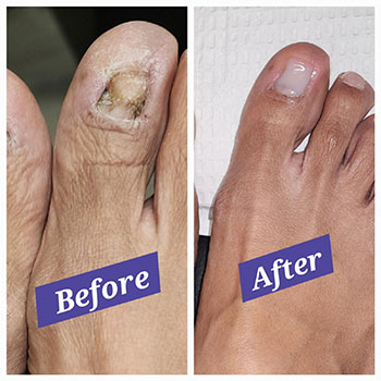 keryflex nail restoration before and after picture