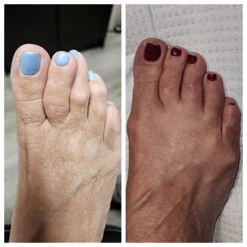 hammertoe repair before and after picture