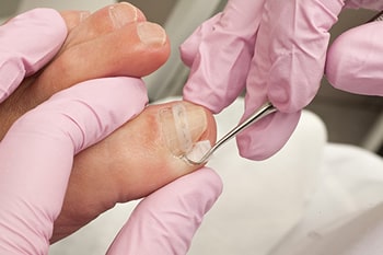 ingrown toenail treatment in the Passaic County, NJ: Clifton (Paterson, Passaic, Wayne, Hawthorne, Clifton), Essex County, NJ: Newark, East Orange, Bloomfield, West Orange, Belleville, Nutley, Montclair, Bergen County, NJ: Rutherford, Garfield and Morris County, NJ: Lincoln Park, Lincoln Park areas